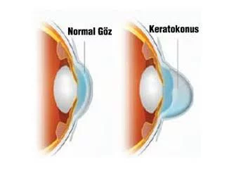 Gözleri Görmeyen Biri Düşünerek Görebilir Mi? 1 Gözleri Görmeyen Biri Düşünerek Görebilir Mi? 1